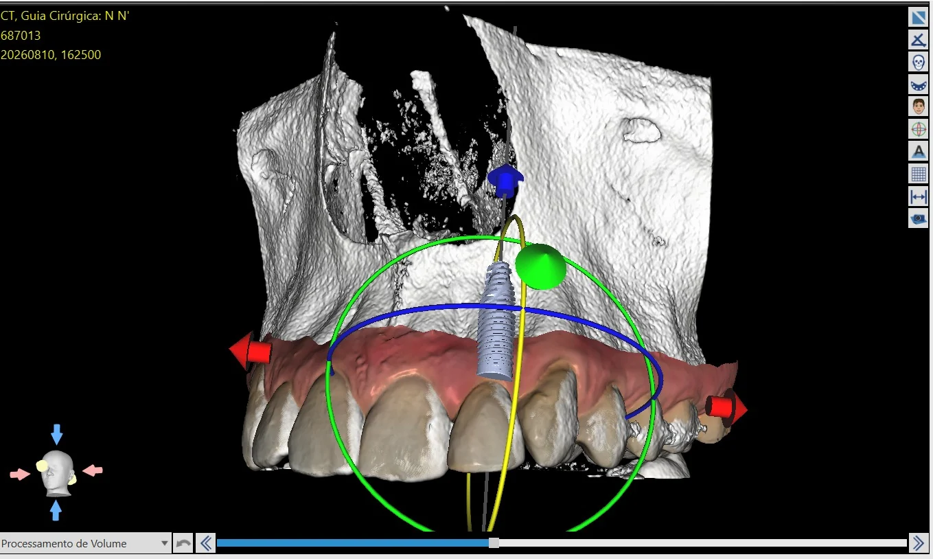 Planejamento cirúrgico virtual para implantes